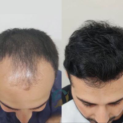 Hair Transplant in Islamabad: Regain Your Natural Hair with Advanced Techniques