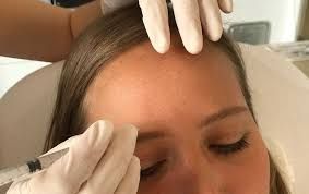 Botulinum Toxin: Moderne Anwendungsmöglichkeiten für ein frisches Erscheinungsbild