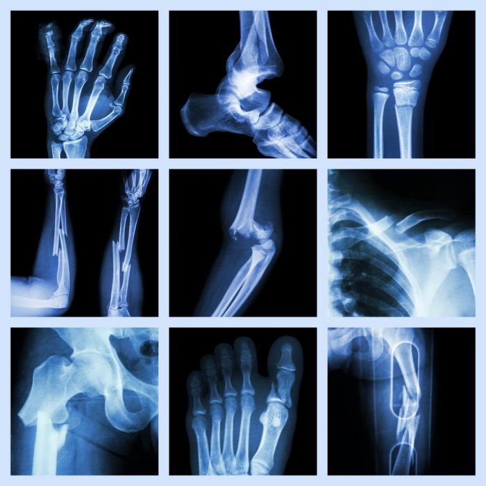 Natural Aids for Broken Bone Recovery
