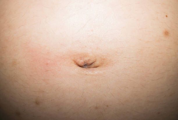 Hernia Surgery Guide for Symptoms, Treatment, and Care