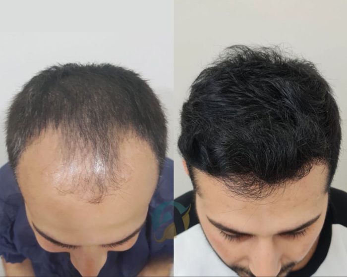 Hair Transplant in Islamabad: Regain Your Natural Hair with Advanced Techniques